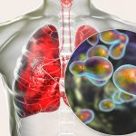 An illustration of an x-ray of a torso that displays human lungs. An inset circular illustration shows a fungus at the microscopic level.