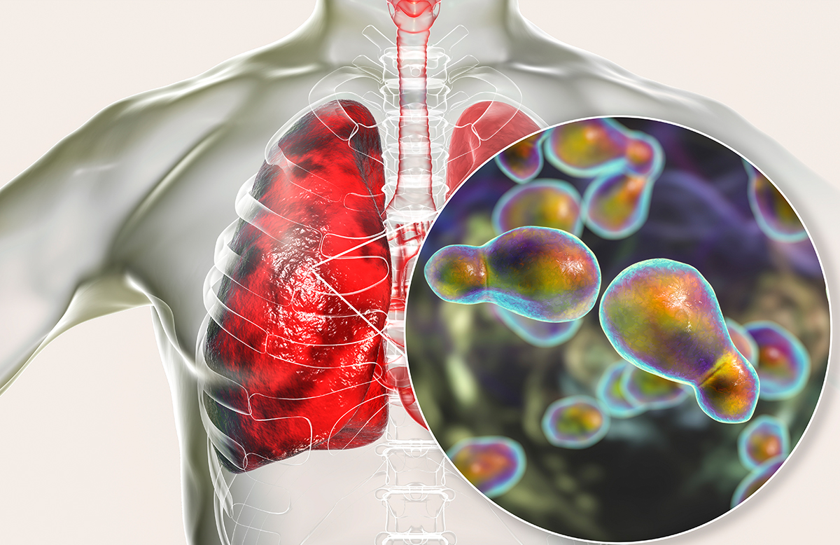 An illustration of an x-ray of a torso that displays human lungs. An inset circular illustration shows a fungus at the microscopic level.